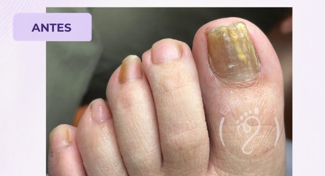 Uña del pie con onicomicosis antes del tratamiento